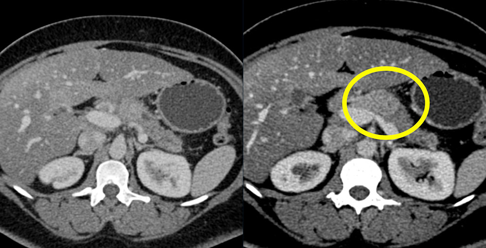 Metastatic Breast Cancer to the Pancreas (dx 2 yrs ago)