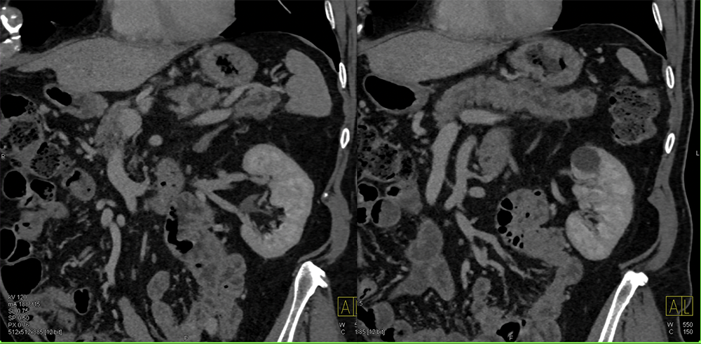 Subtle Cancer Body of the Pancreas