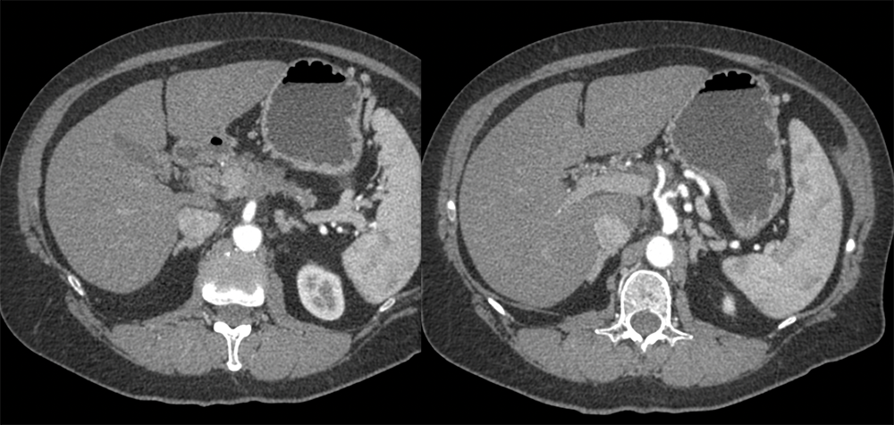 Adenocarcinoma Pancreas with Subtle Arterial Involvement