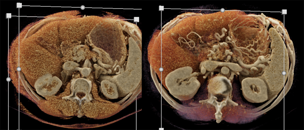 Adenocarcinoma Pancreas with Subtle Arterial Involvement