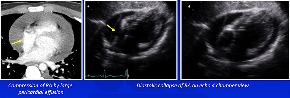 Diastolic Collapse of RA and RV