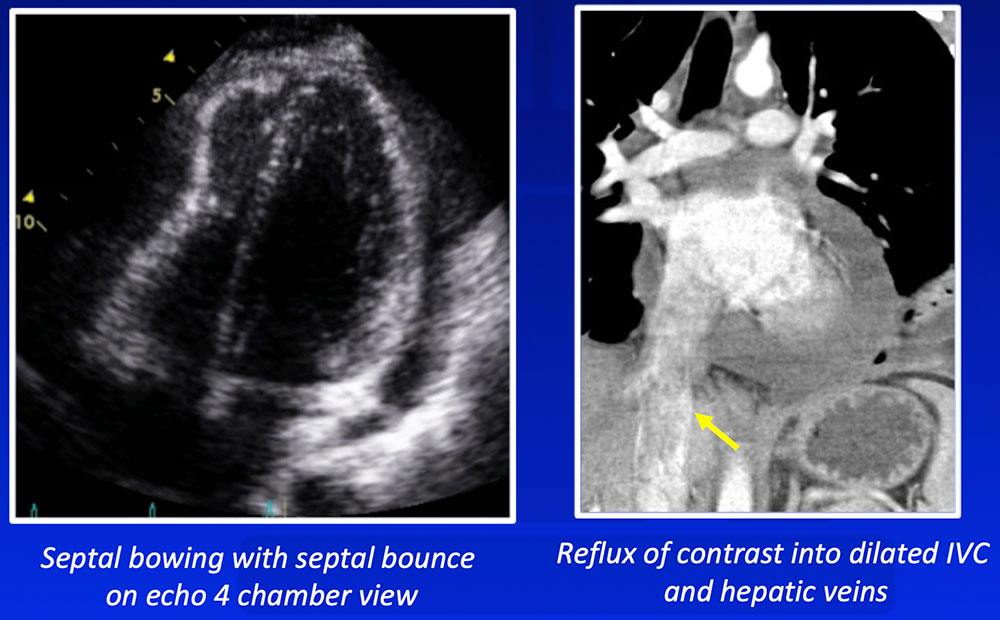 Septal Bowing and Reflux into IVC/Hepatic Veins