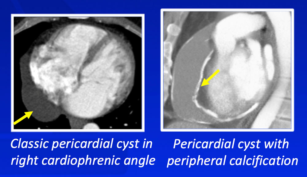 Pericardial Cyst