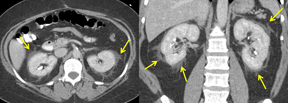 Perinephric Fat Ultrasound