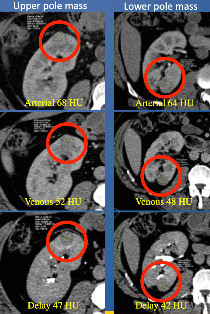 Hepatic Metastasis 