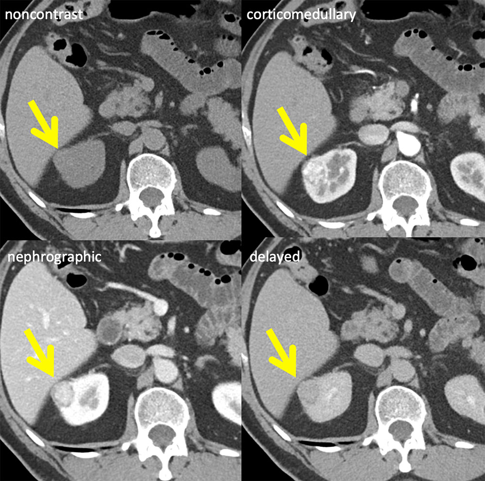 Clear Cell RCC Case