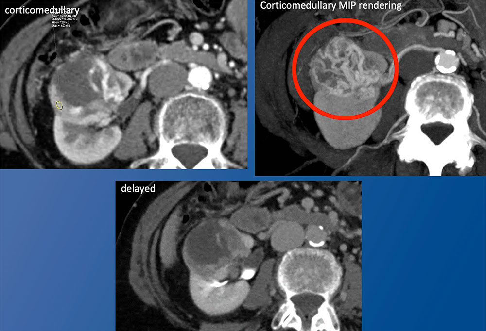 CT Findings Aiding in Surgical Planning