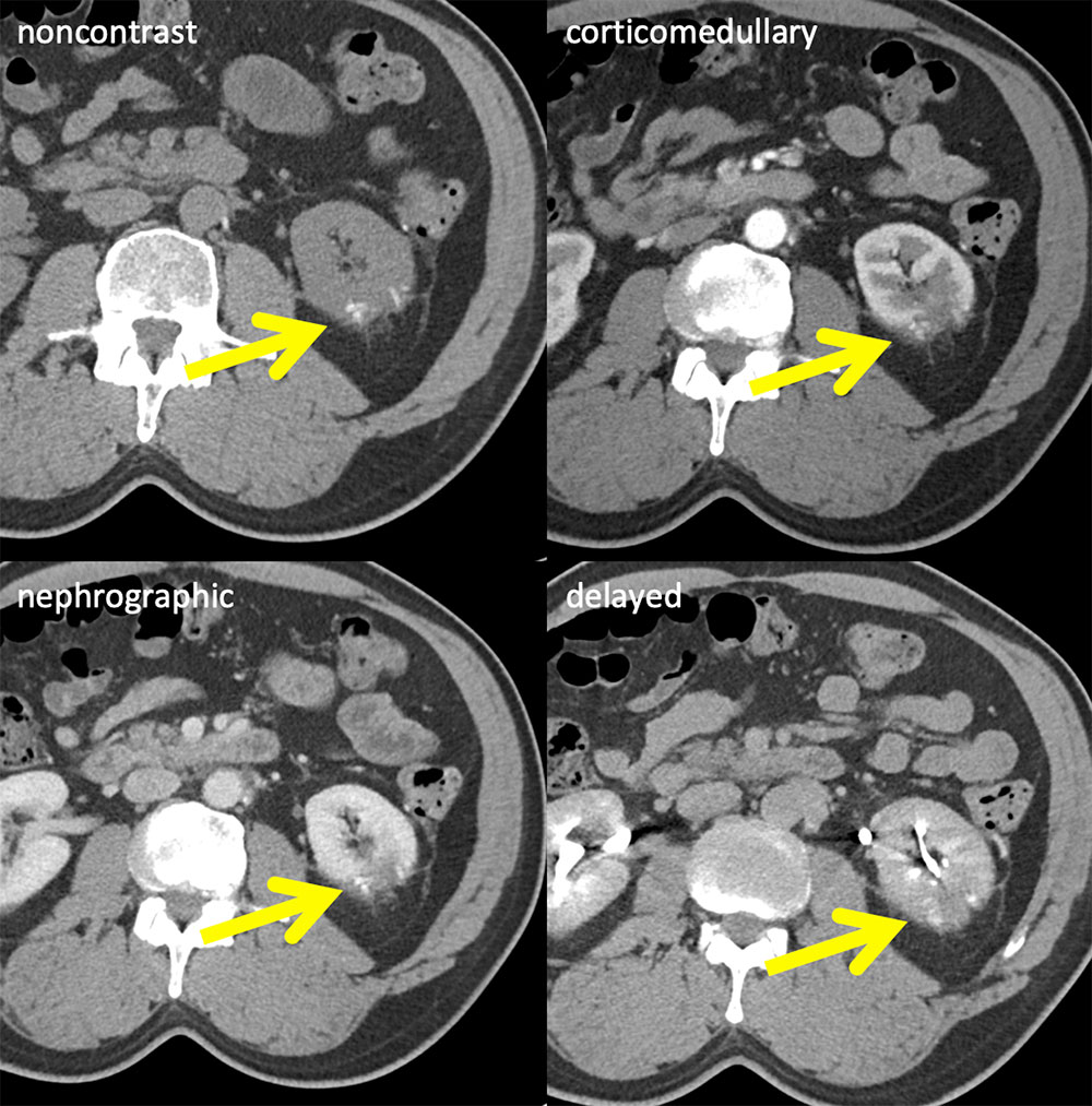 Partial Nephrectomy:Surgical Material vs Tumor
