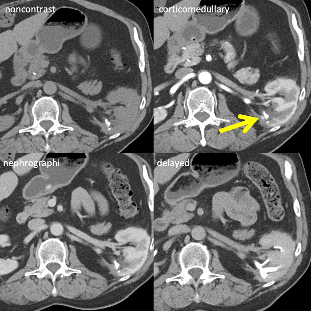 Partial Nephrectomy:Surgical Material vs Tumor