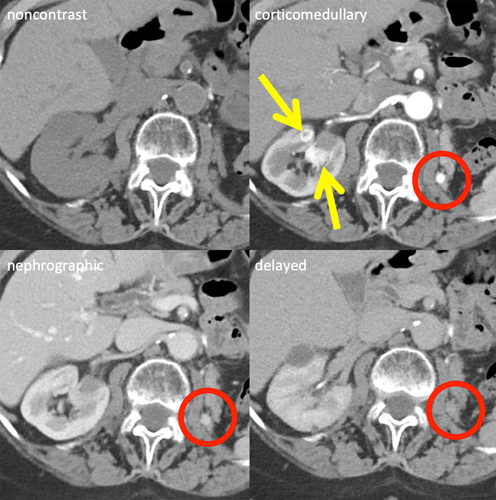 Pancreatic and Contralateral Kidney Metastases