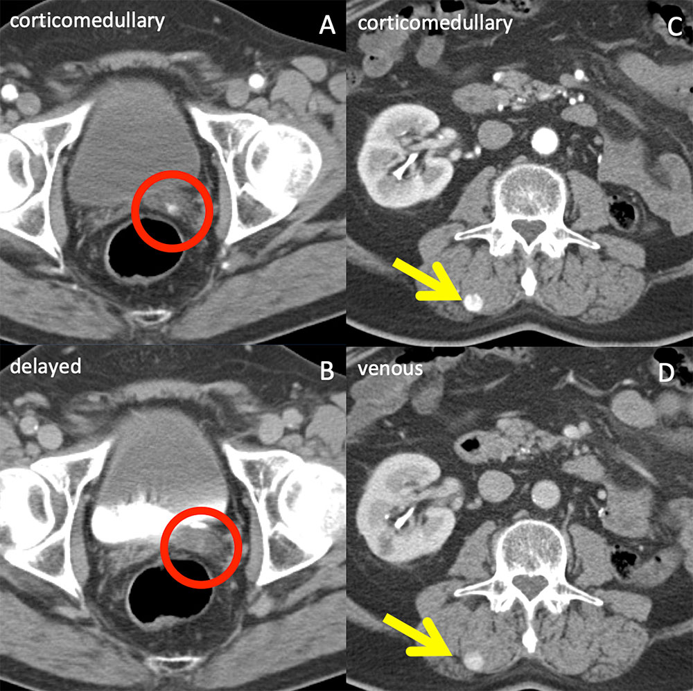 Clear Cell RCC Metastasis