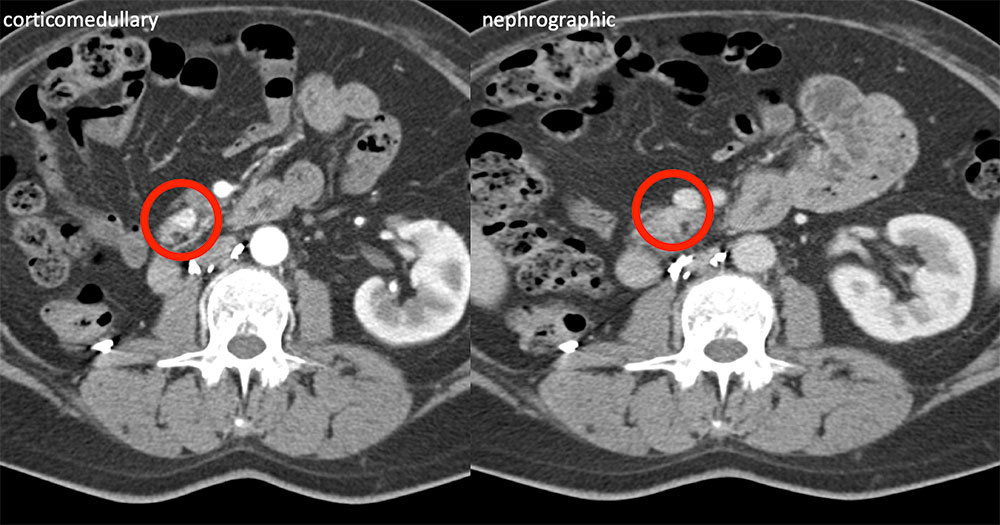 Pancreatic Uncinate Metastasis