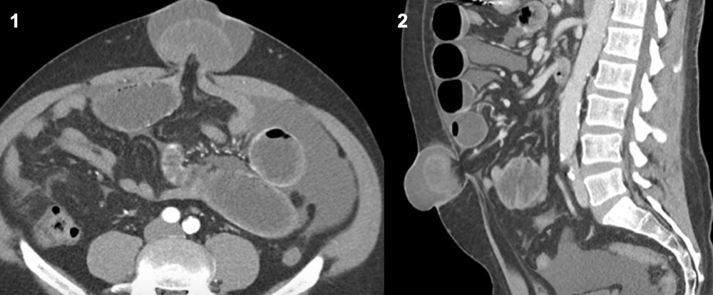 Case 1: History of cirrhosis with palpable abdominal mass