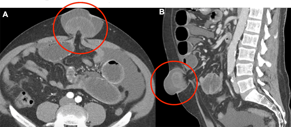 Case 1: Strangulated umbilical hernia