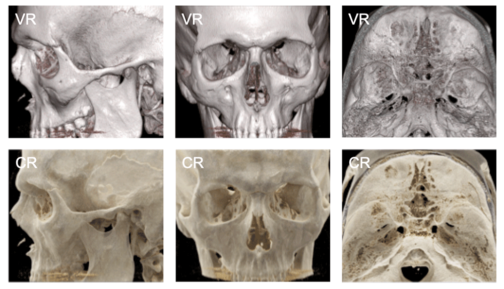 Calvarial, Skull Base, and Maxillofacial Normal Anatomy