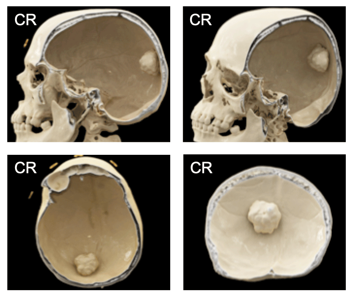 Calvarial, Skull Base, and Maxillofacial Anatomy and Pathology