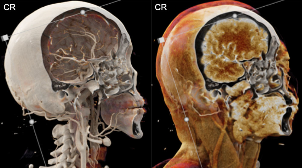 Calvarial, Skull Base, and Maxillofacial Normal Anatomy