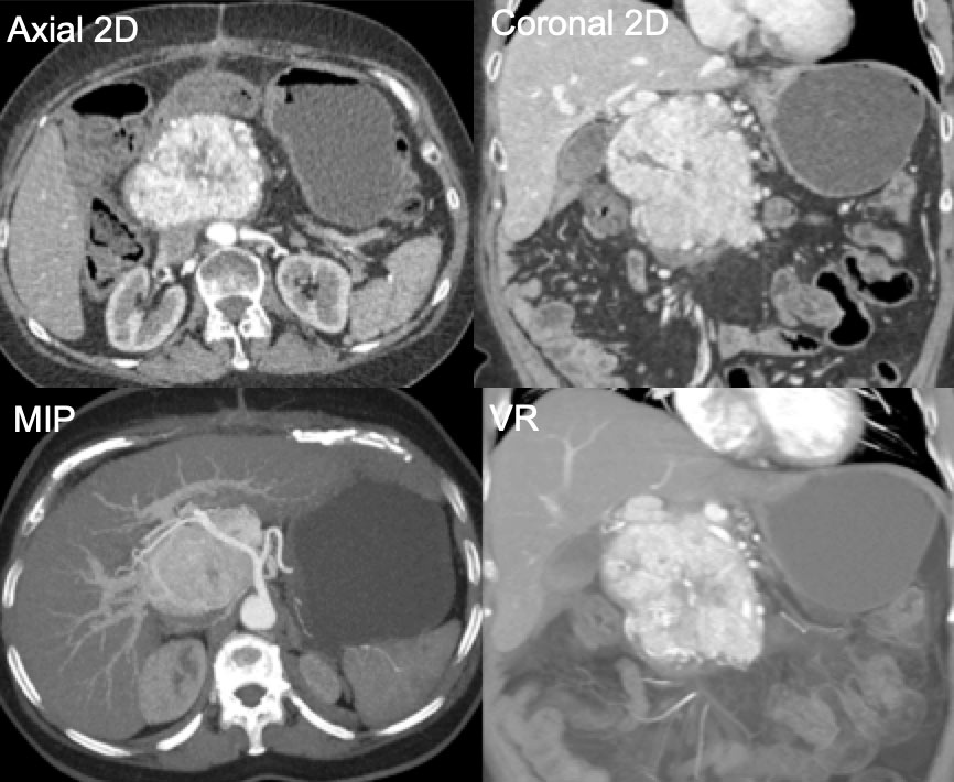Pancreatic Neuroendocrine Tumor with Extensive Neovascularity