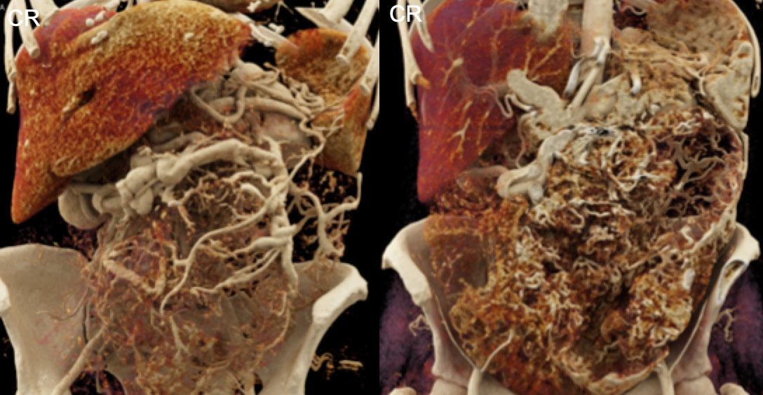 Large, Highly-Vascular Gastro-Intestinal Stromal Tumor