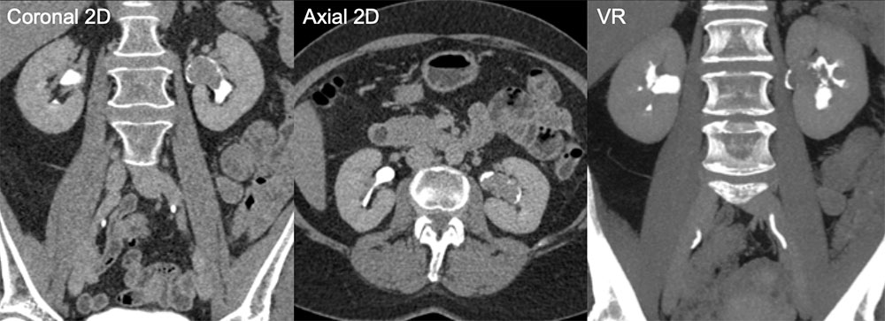 Another Example of Left Kidney Transitional Cell Carcinoma