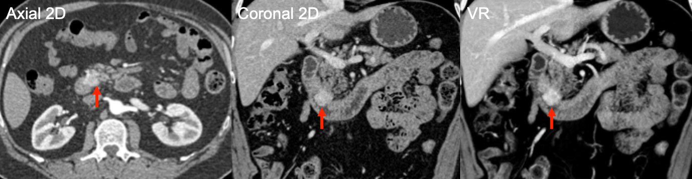 Small Bowel Gastrointestinal Stromal Tumor