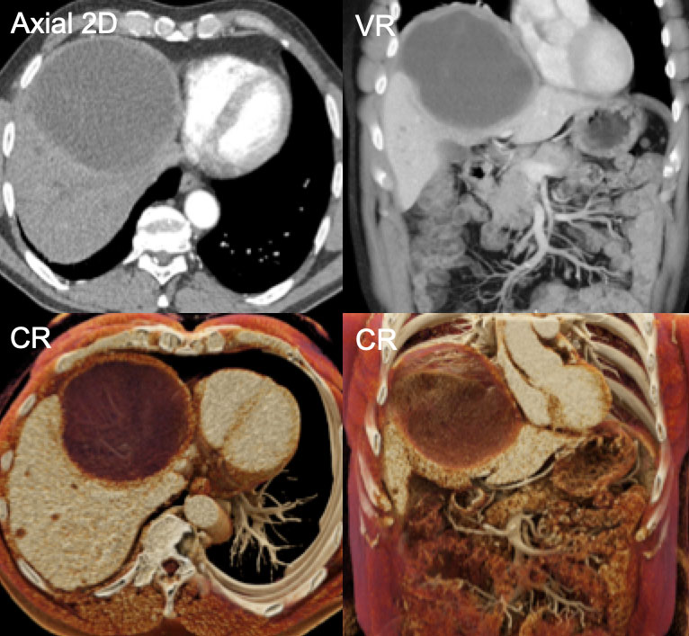 Treated Gastrointestinal Stromal Tumor Liver Metastasis