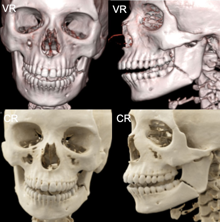 Mandibular Fracture