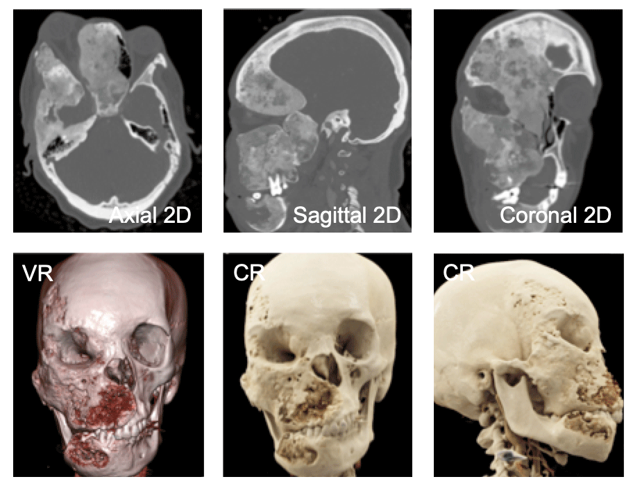 Polyostotic Fibrous Dysplasia