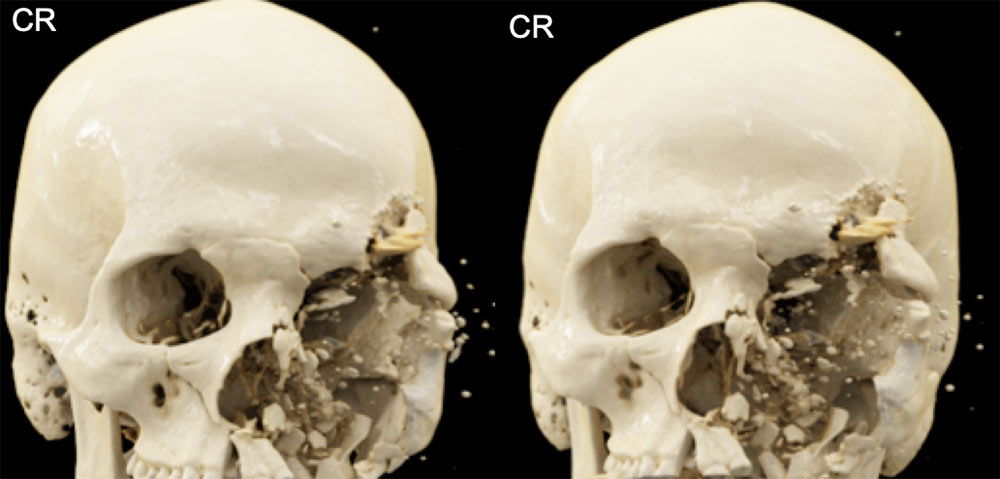 Gunshot Wound with Extensive Facial Fractures