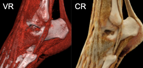 Cinematic Vs. Volume Rendering for Soft Tissue Evaluation