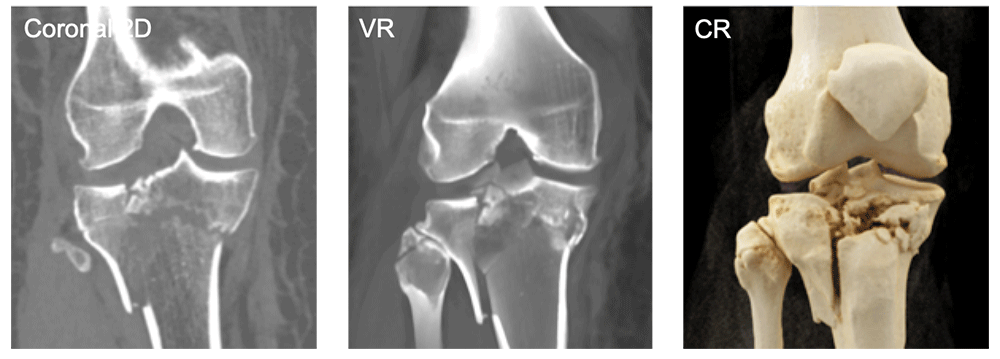 Tibial Plateau and Fibular Fractures