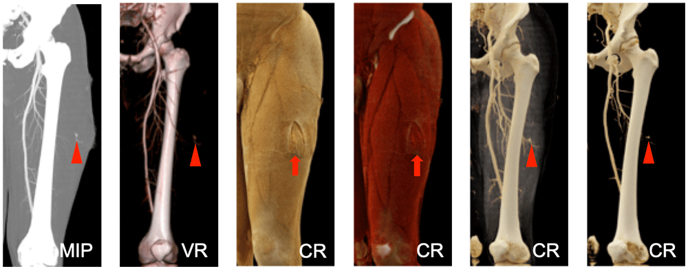 Soft Tissue Injuries are Well-Delineated by Cinematic Rendering