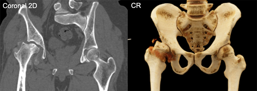 Hip Dysplasia