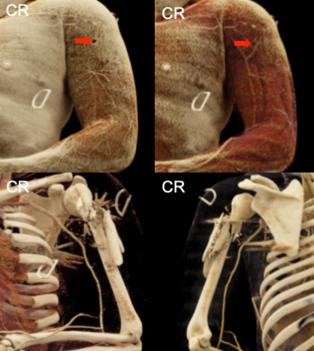 Ballistic Fracture of the Humerus