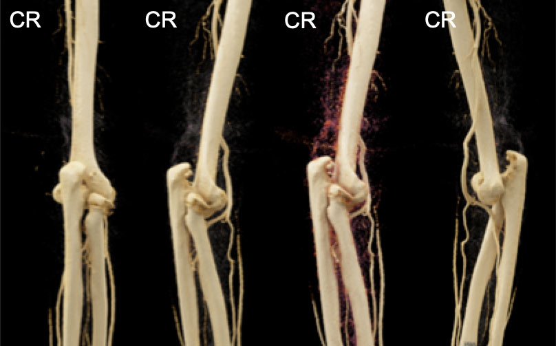 Radial Head Fracture and Elbow Joint Dislocation