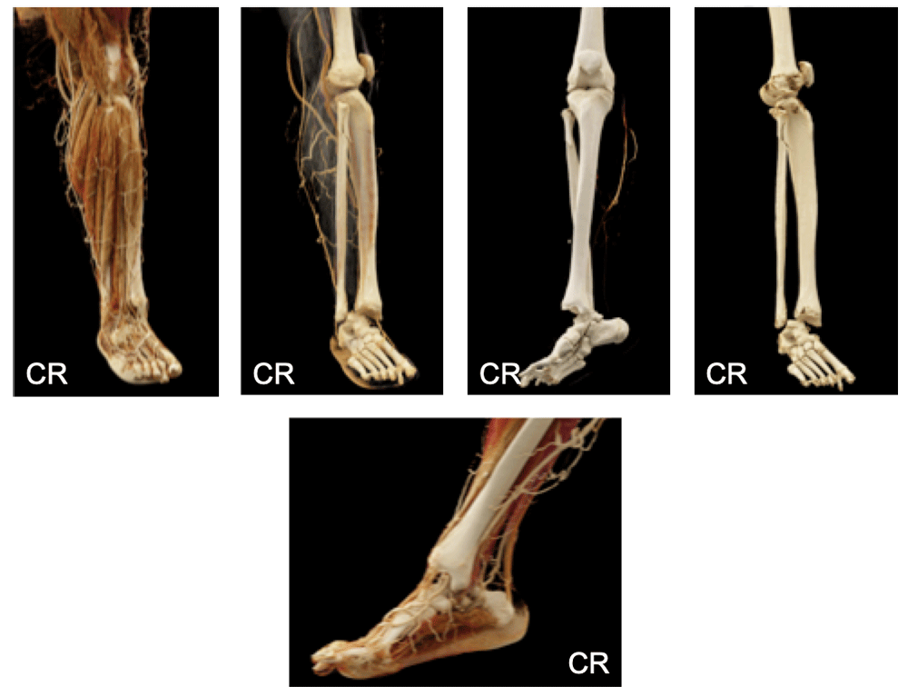 Ankle Joint Dislocation with Fibula Fracture