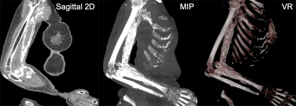 Dermatomyositis with Soft Tissue Calcifications