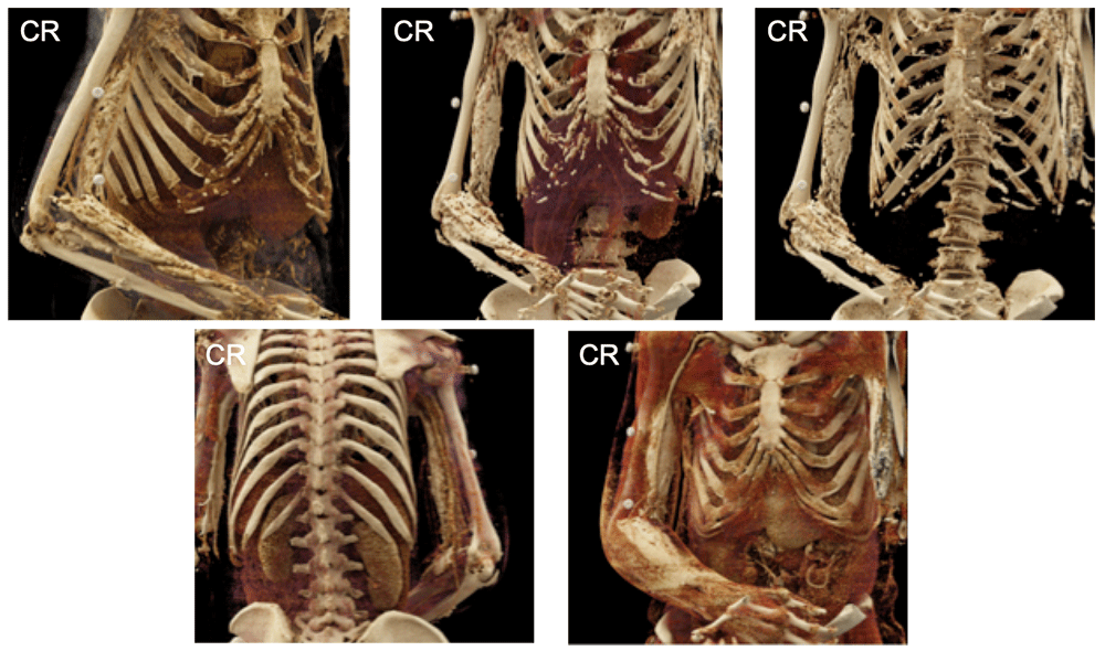 Dermatomyositis with Soft Tissue Calcifications