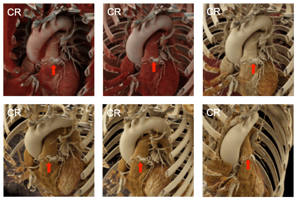 Coronary Artery to Pulmonary Artery Fistula