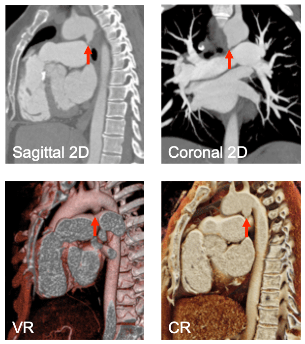 Ductus Diverticulum – Potential Pitfall for an Acute Aortic Injury