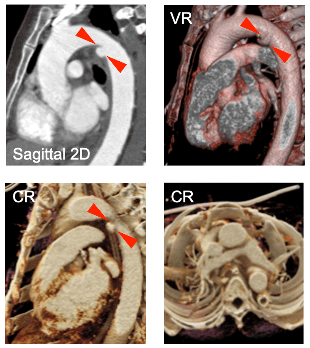 Acute Aortic Injury