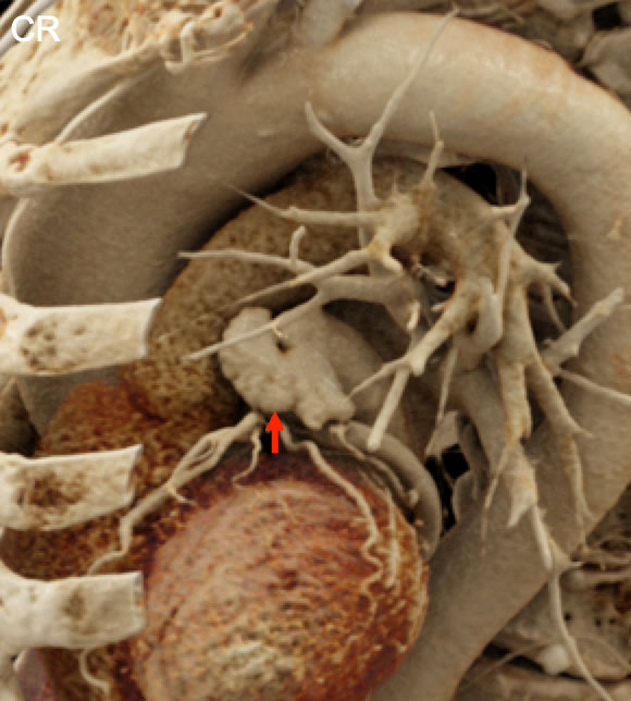 Normal Anatomy: Highly Detailed View of the Left Atrial Appendage