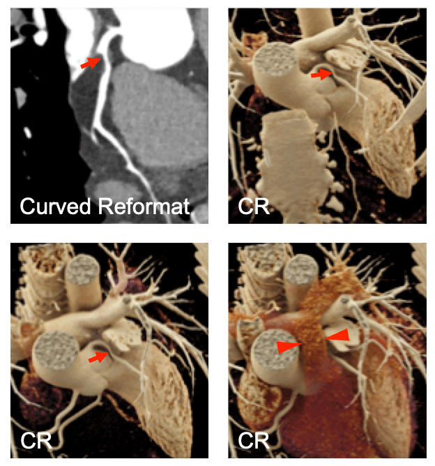 Approximately 50% Stenosis in the LAD