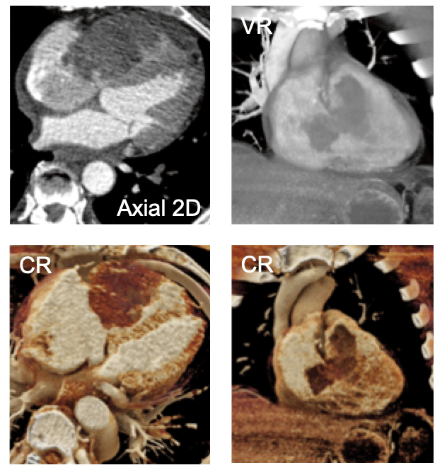 Intracardiac Spindle Cell Tumor