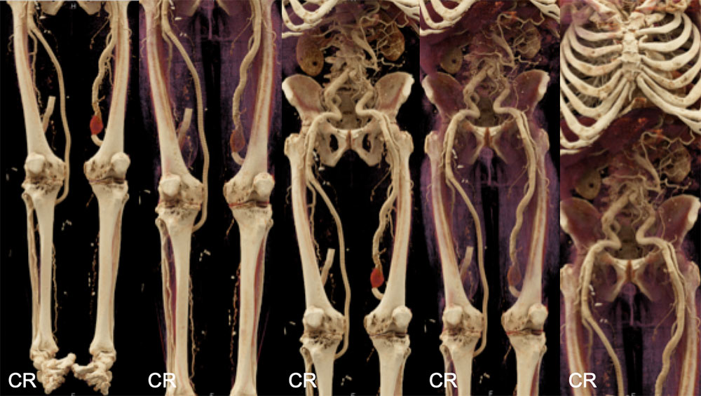 Peripheral Vascular Grafts in a Patient with Loeys-Dietz Syndrome