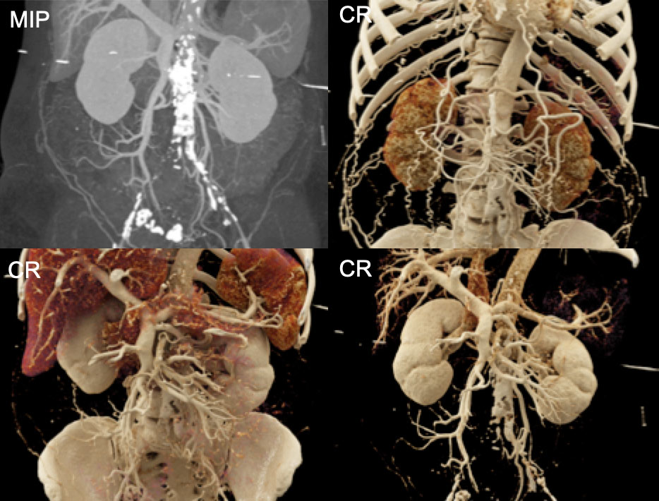 Distal Aortic Occlusion with Collateral Vessel Formation