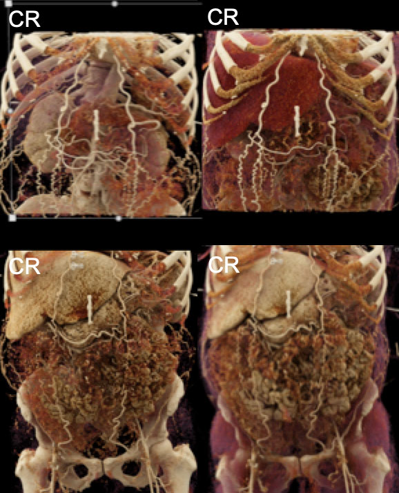 Distal Aortic Occlusion with Collateral Vessel Formation