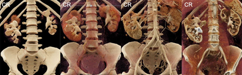 Bilateral Staghorn Calculi