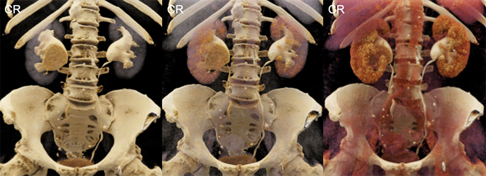 Bilateral Asymptomatic Ureteropelvic Junction Obstructions