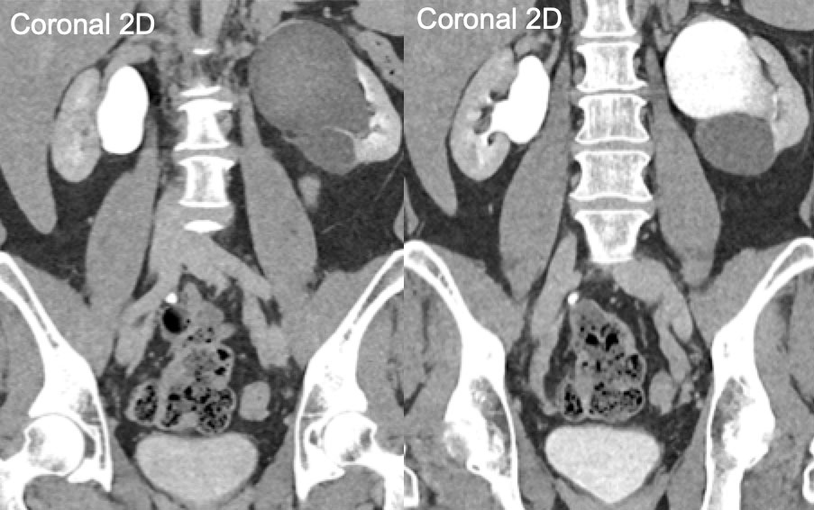 Ureteropelvic Junction Obstruction Due to Crossing Vessel